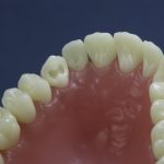 Differentiated Teeth 112