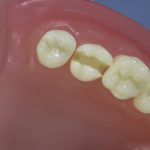 Dentes Diferenciados 97