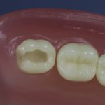 Dentes Diferenciados 11